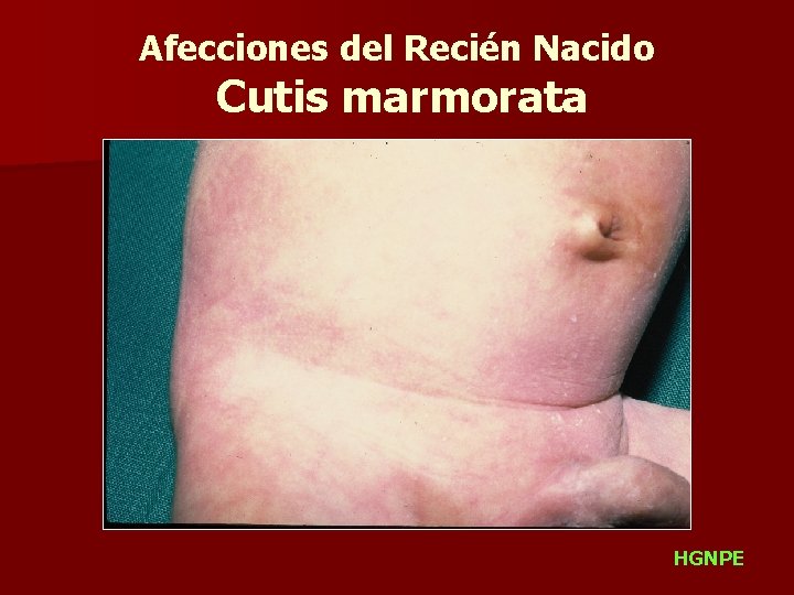 Afecciones del Recién Nacido Cutis marmorata HGNPE 