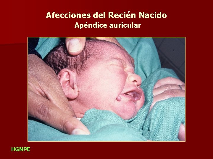 Afecciones del Recién Nacido Apéndice auricular HGNPE 