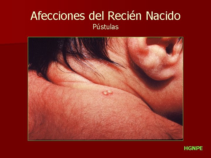 Afecciones del Recién Nacido Pústulas HGNPE 