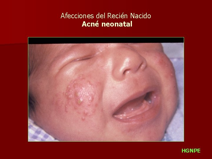 Afecciones del Recién Nacido Acné neonatal HGNPE 