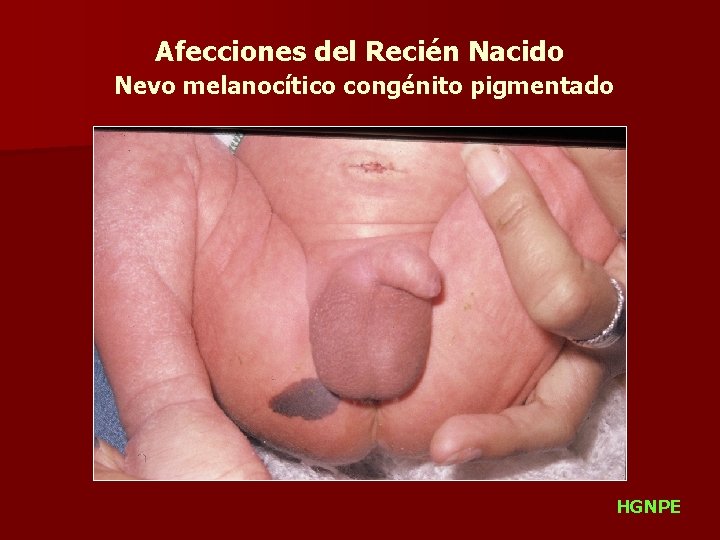 Afecciones del Recién Nacido Nevo melanocítico congénito pigmentado HGNPE 
