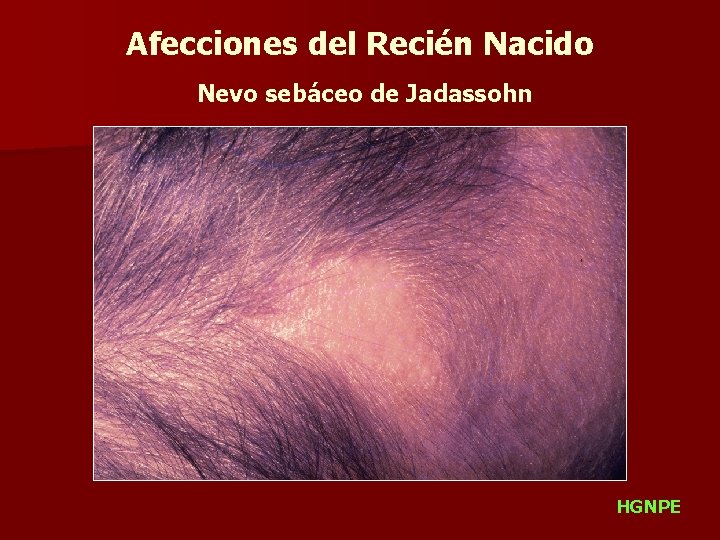 Afecciones del Recién Nacido Nevo sebáceo de Jadassohn HGNPE 