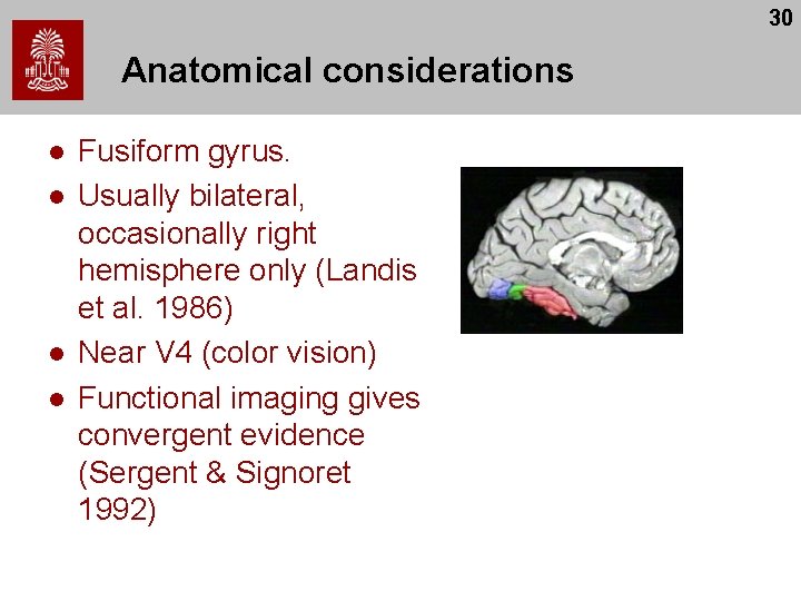 30 Anatomical considerations l l Fusiform gyrus. Usually bilateral, occasionally right hemisphere only (Landis