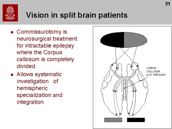 31 Vision in split brain patients l l Commissurotomy is neurosurgical treatment for intractable