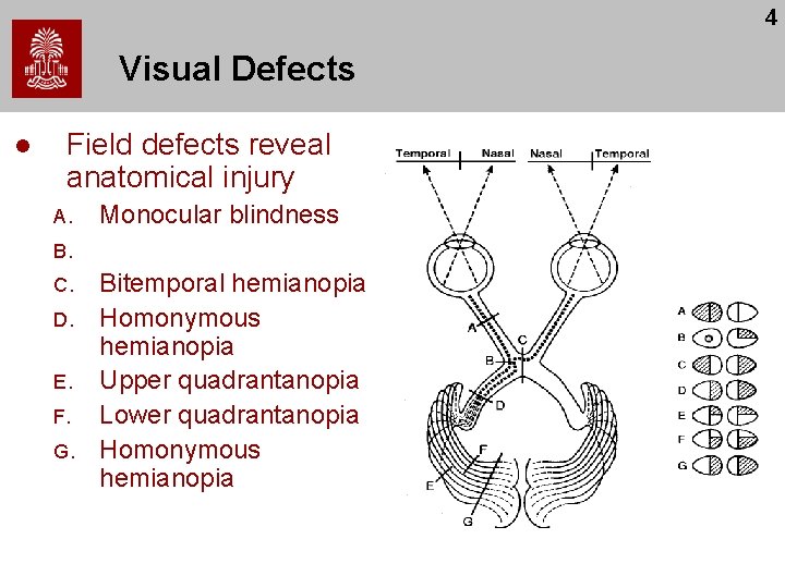 4 Visual Defects l Field defects reveal anatomical injury A. Monocular blindness B. C.