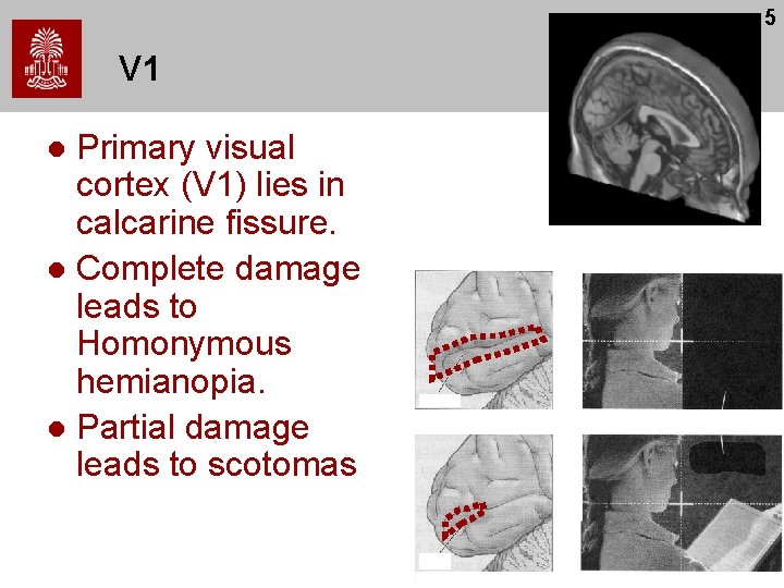5 V 1 Primary visual cortex (V 1) lies in calcarine fissure. l Complete