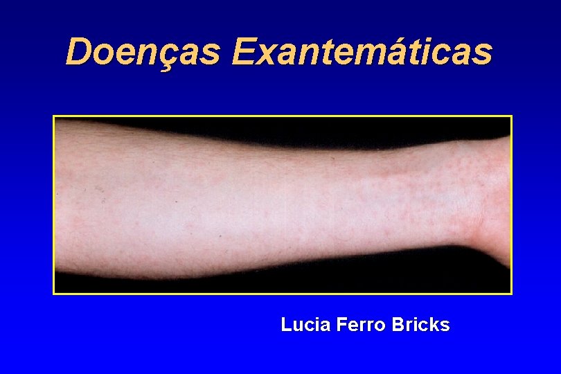 Doenças Exantemáticas Lucia Ferro Bricks 