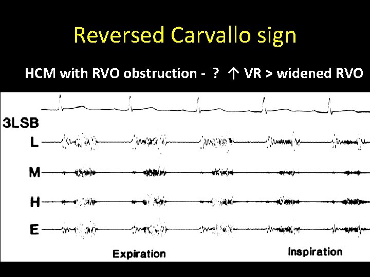 Reversed Carvallo sign HCM with RVO obstruction - ? ↑ VR > widened RVO