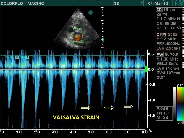 VALSALVA STRAIN 