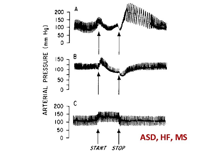 ASD, HF, MS 