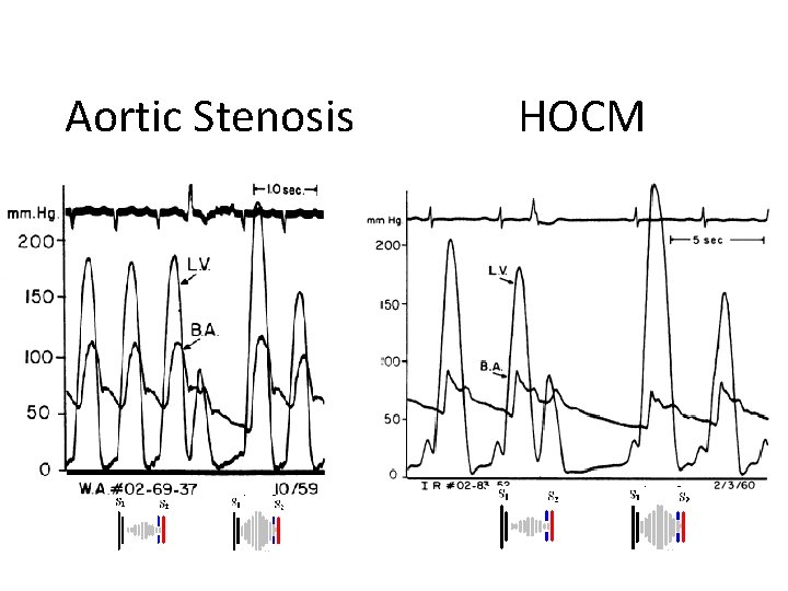 Aortic Stenosis HOCM 