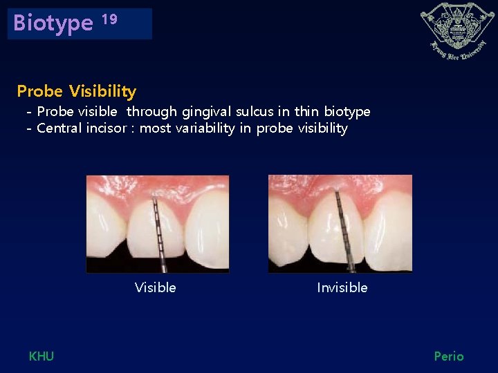 Biotype 19 Probe Visibility - Probe visible through gingival sulcus in thin biotype -