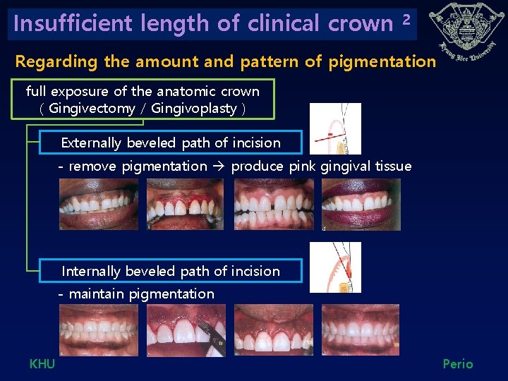 Insufficient length of clinical crown 2 Regarding the amount and pattern of pigmentation full