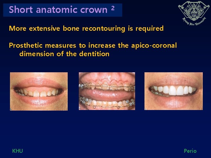 Short anatomic crown 2 More extensive bone recontouring is required Prosthetic measures to increase