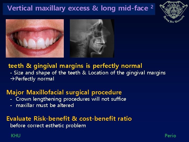 Vertical maxillary excess & long mid-face 2 teeth & gingival margins is perfectly normal