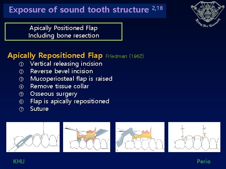 Exposure of sound tooth structure 2, 18 Apically Positioned Flap Including bone resection Apically