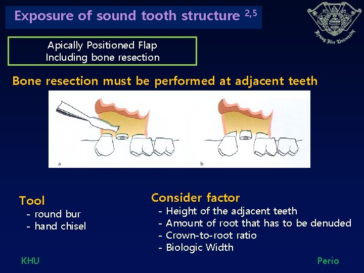 Exposure of sound tooth structure 2, 5 Apically Positioned Flap Including bone resection Bone