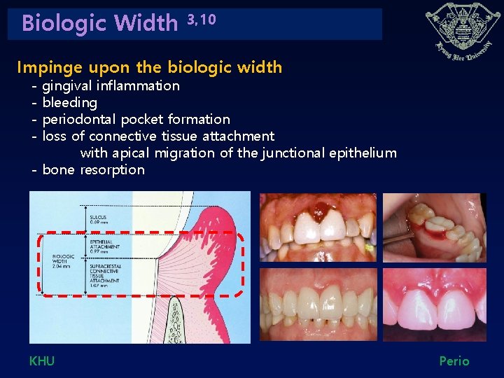 Biologic Width 3, 10 Impinge upon the biologic width - gingival inflammation bleeding periodontal