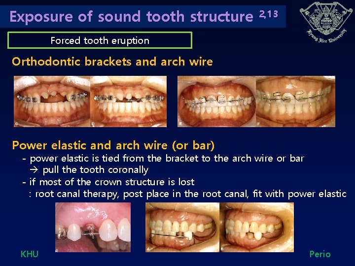 Exposure of sound tooth structure 2, 13 Forced tooth eruption Orthodontic brackets and arch