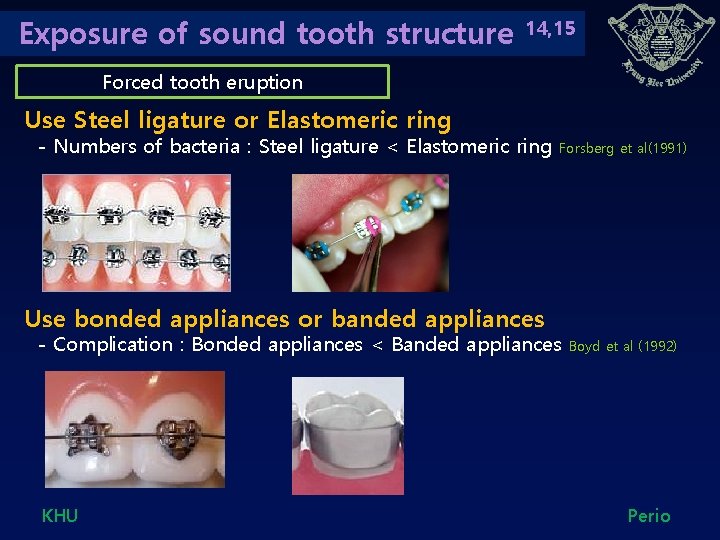 Exposure of sound tooth structure 14, 15 Forced tooth eruption Use Steel ligature or