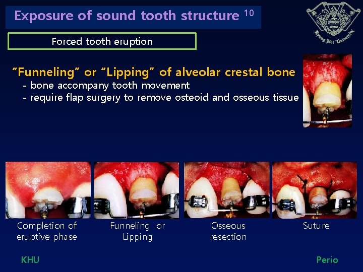 Exposure of sound tooth structure 10 Forced tooth eruption “Funneling” or “Lipping” of alveolar