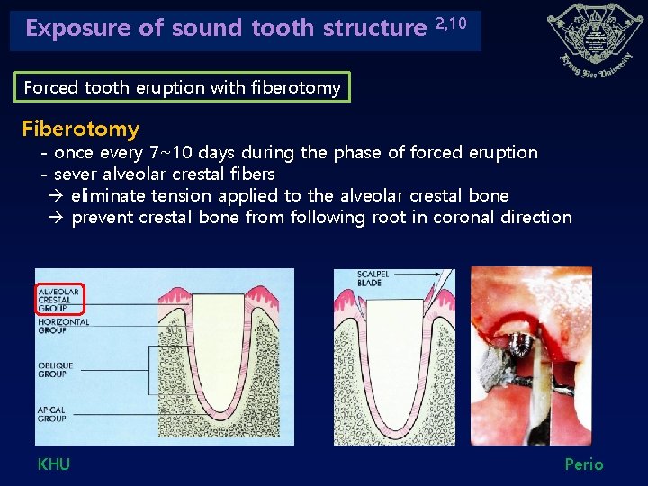 Exposure of sound tooth structure 2, 10 Forced tooth eruption with fiberotomy Fiberotomy -