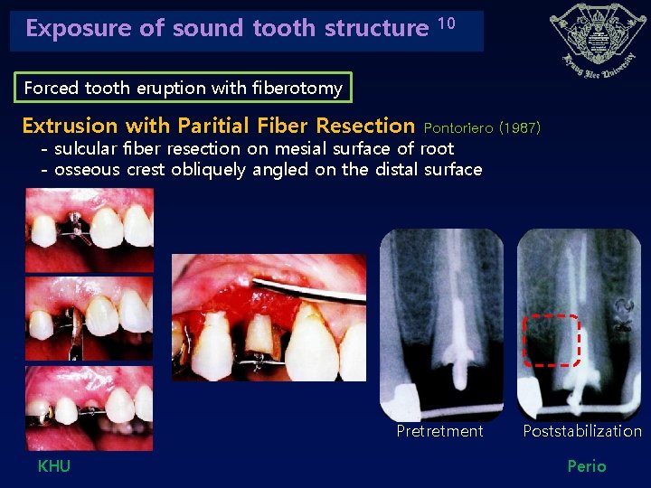 Exposure of sound tooth structure 10 Forced tooth eruption with fiberotomy Extrusion with Paritial