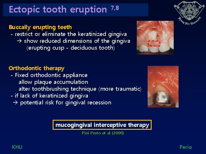 Ectopic tooth eruption 7, 8 Buccally erupting teeth - restrict or eliminate the keratinized