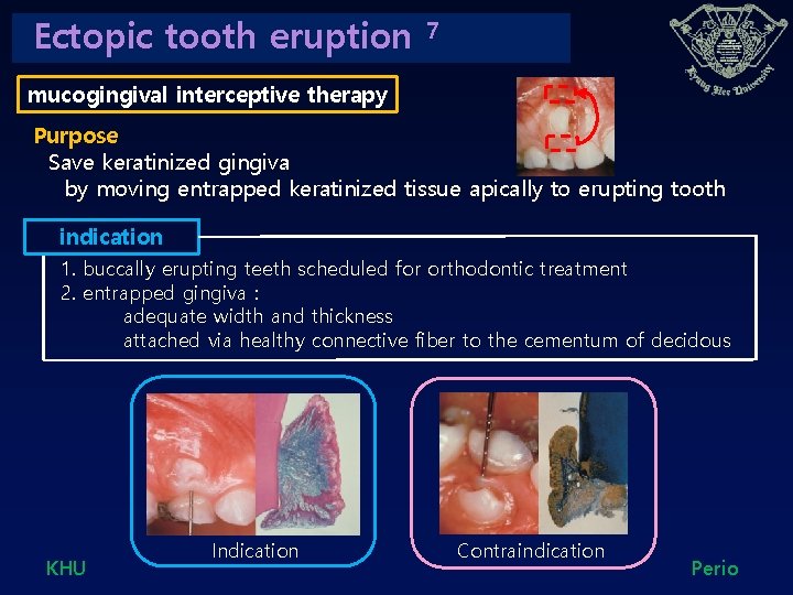 Ectopic tooth eruption 7 mucogingival interceptive therapy Purpose Save keratinized gingiva by moving entrapped