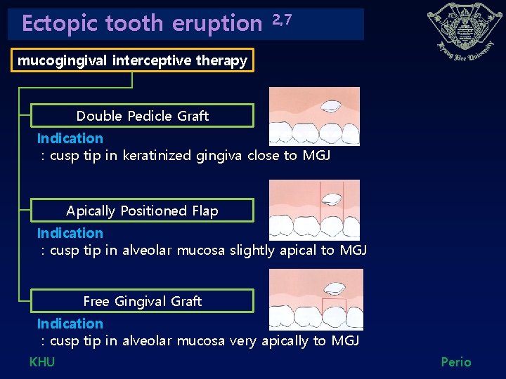 Ectopic tooth eruption 2, 7 mucogingival interceptive therapy Double Pedicle Graft Indication : cusp