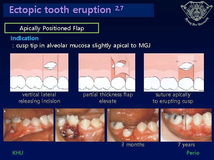 Ectopic tooth eruption 2, 7 Apically Positioned Flap Indication : cusp tip in alveolar Ectopic tooth eruption 2, 7 Apically Positioned Flap Indication : cusp tip in alveolar