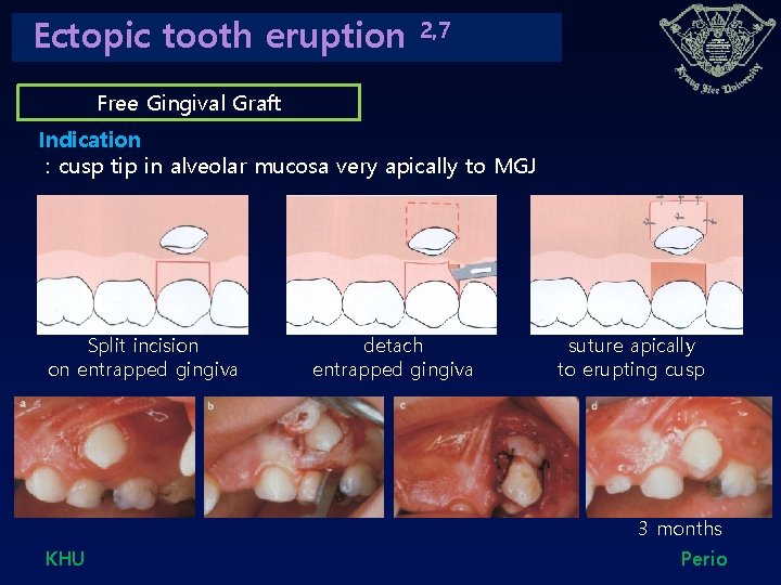 Ectopic tooth eruption 2, 7 Free Gingival Graft Indication : cusp tip in alveolar