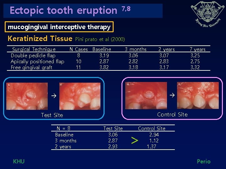 Ectopic tooth eruption 7, 8 mucogingival interceptive therapy Keratinized Tissue 　Surgical Technique Double pedicle