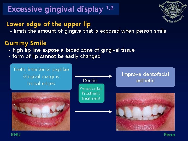 Excessive gingival display 1, 2 Lower edge of the upper lip - limits the