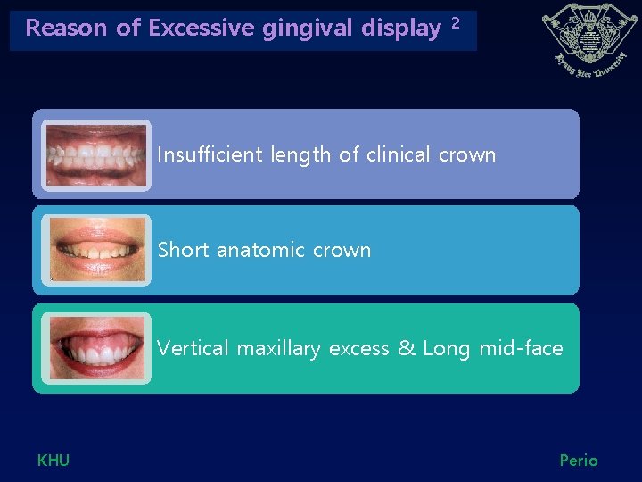 Reason of Excessive gingival display 2 Insufficient length of clinical crown Short anatomic crown