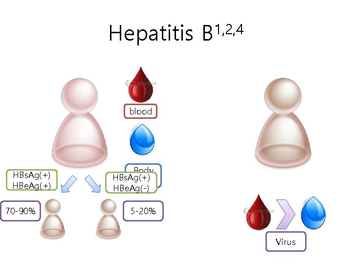 Hepatitis B 1, 2, 4 blood HBs. Ag(+) HBe. Ag(+) 70 -90% Body HBs.