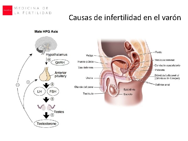 Causas de infertilidad en el varón Causas de infertilidad en el varón