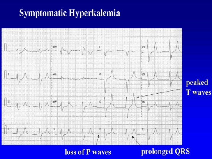 Hyperkalemia 2020/11/2 