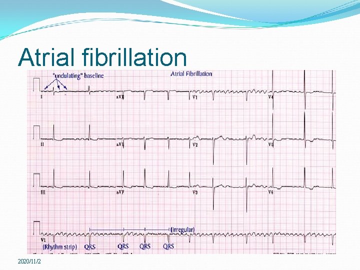 Atrial fibrillation 2020/11/2 