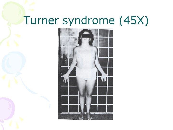 Turner syndrome (45 X) 