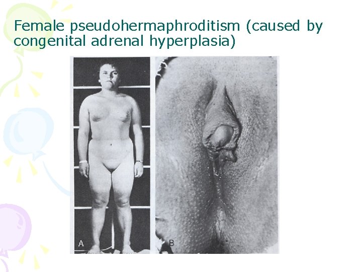 Female pseudohermaphroditism (caused by congenital adrenal hyperplasia) 