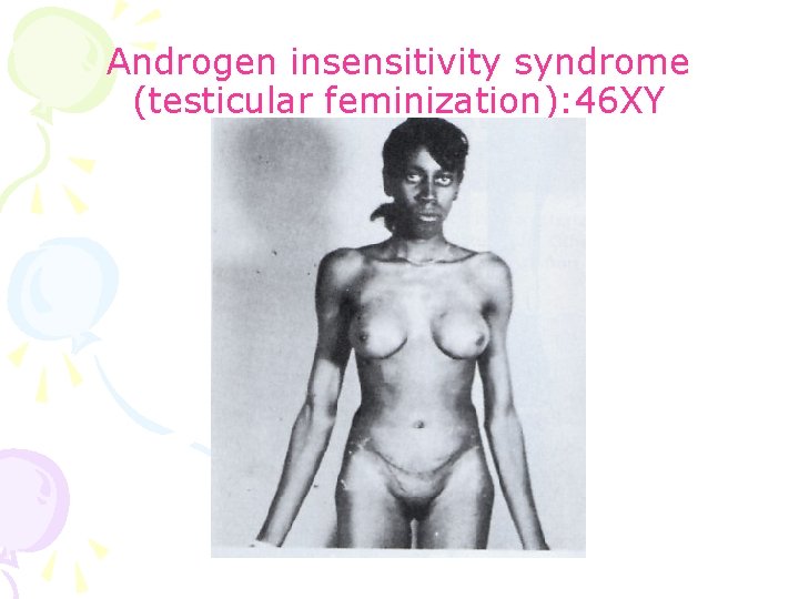 Androgen insensitivity syndrome (testicular feminization): 46 XY 