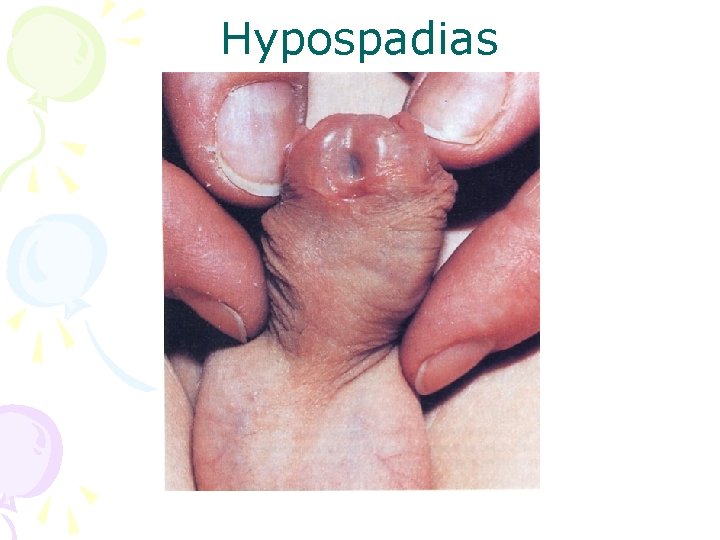 Hypospadias 