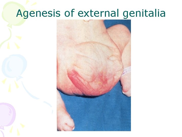 Agenesis of external genitalia 