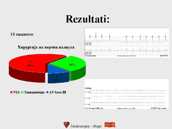Rezultati: 10 пациенти Cardiosurgery - Skopje 