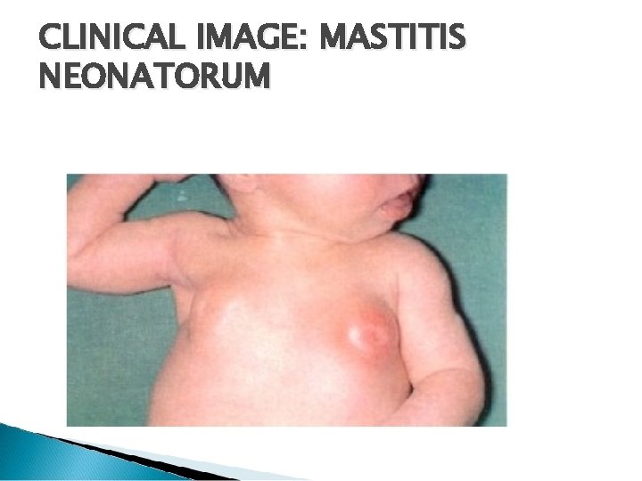 CLINICAL IMAGE: MASTITIS NEONATORUM 