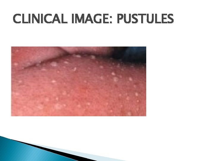 CLINICAL IMAGE: PUSTULES 