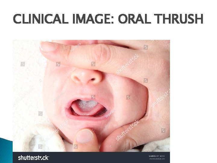 CLINICAL IMAGE: ORAL THRUSH 