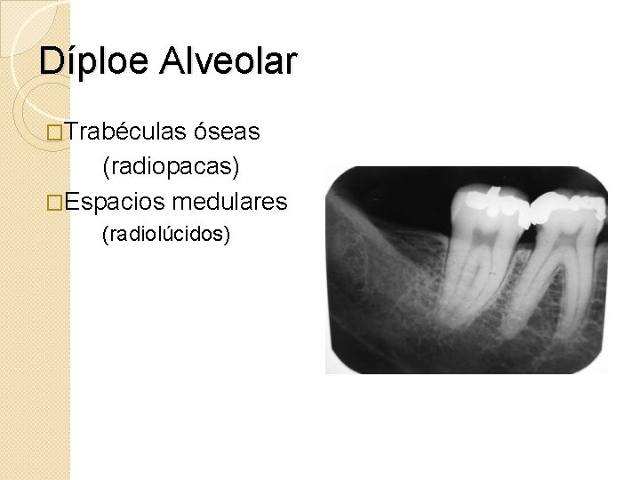 Díploe Alveolar �Trabéculas óseas (radiopacas) �Espacios medulares (radiolúcidos) 