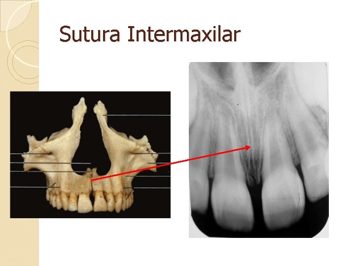 Sutura Intermaxilar 